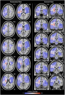 Compensatory increase in ipsilesional supplementary motor area and premotor connectivity is associated with greater gait impairments: a personalized fMRI analysis in chronic stroke