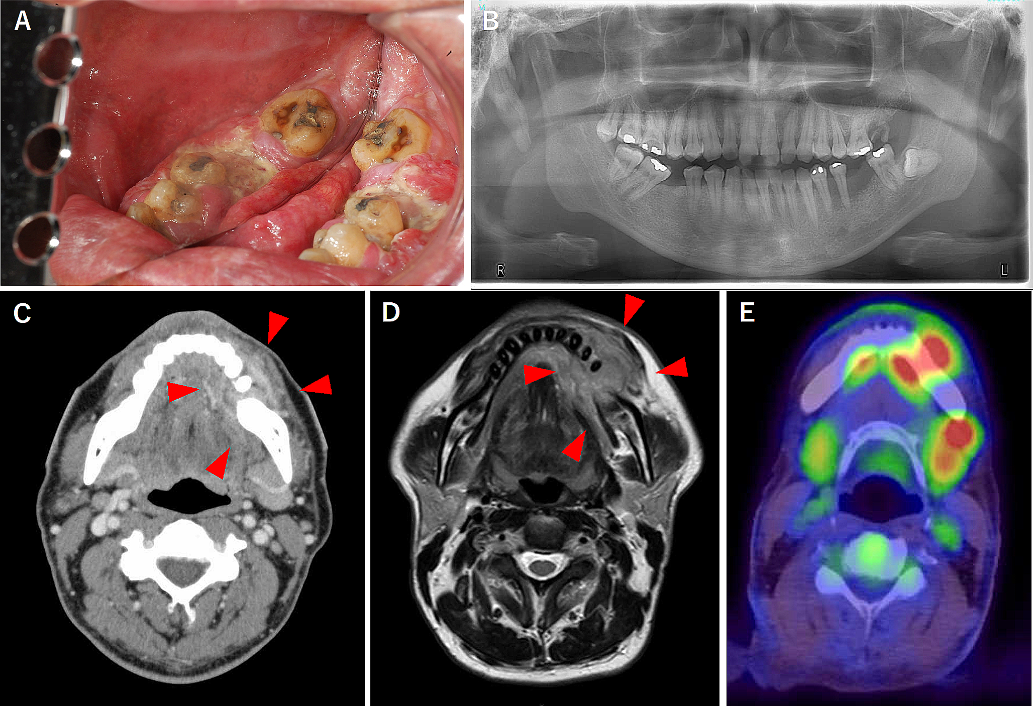 Squamous cell carcinoma of mandibular gingiva producing both parathyroid hormone-related protein and granulocyte colony-stimulating factor: a case report
