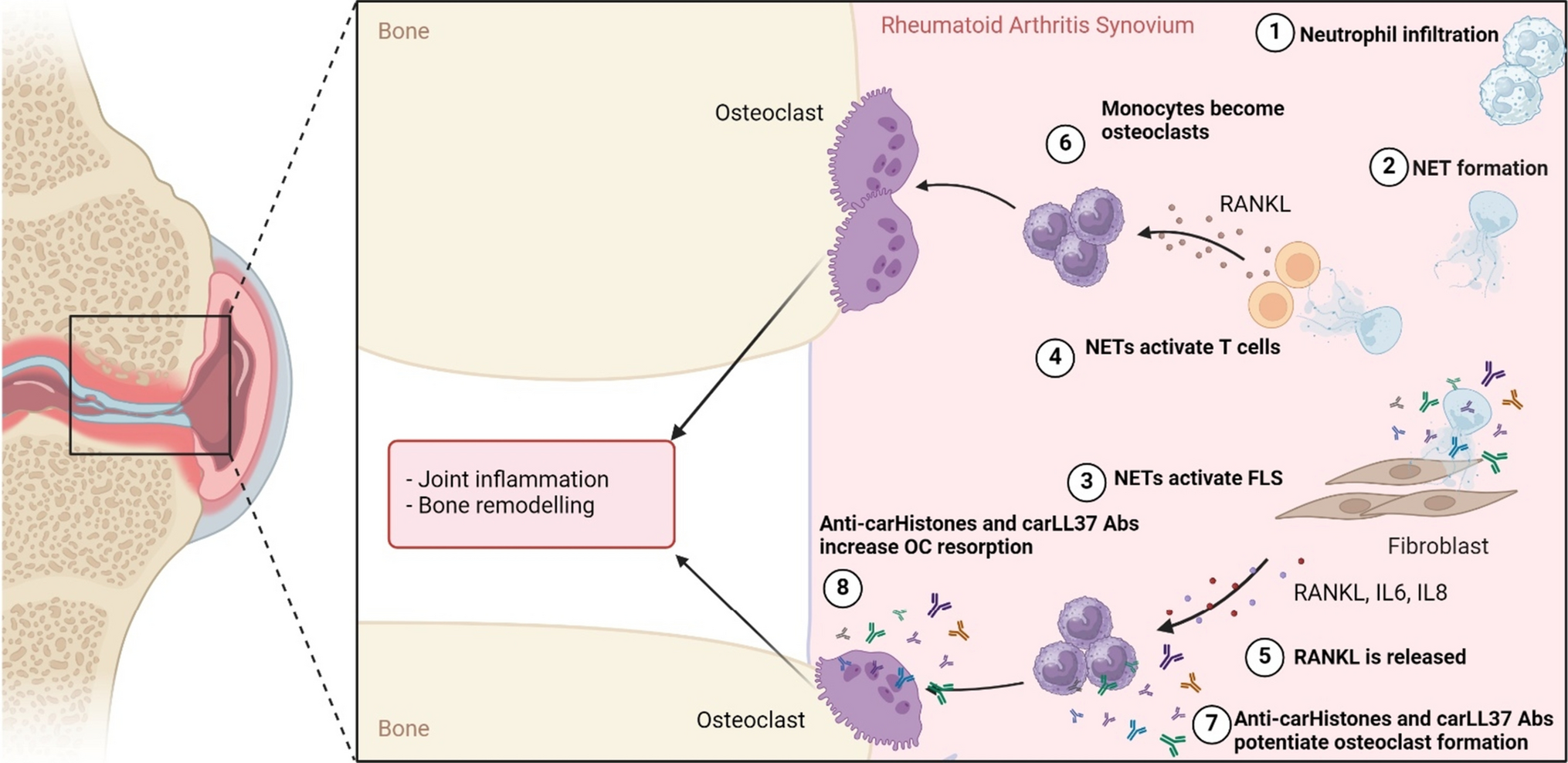 Neutrophils in Inflammatory Bone Diseases