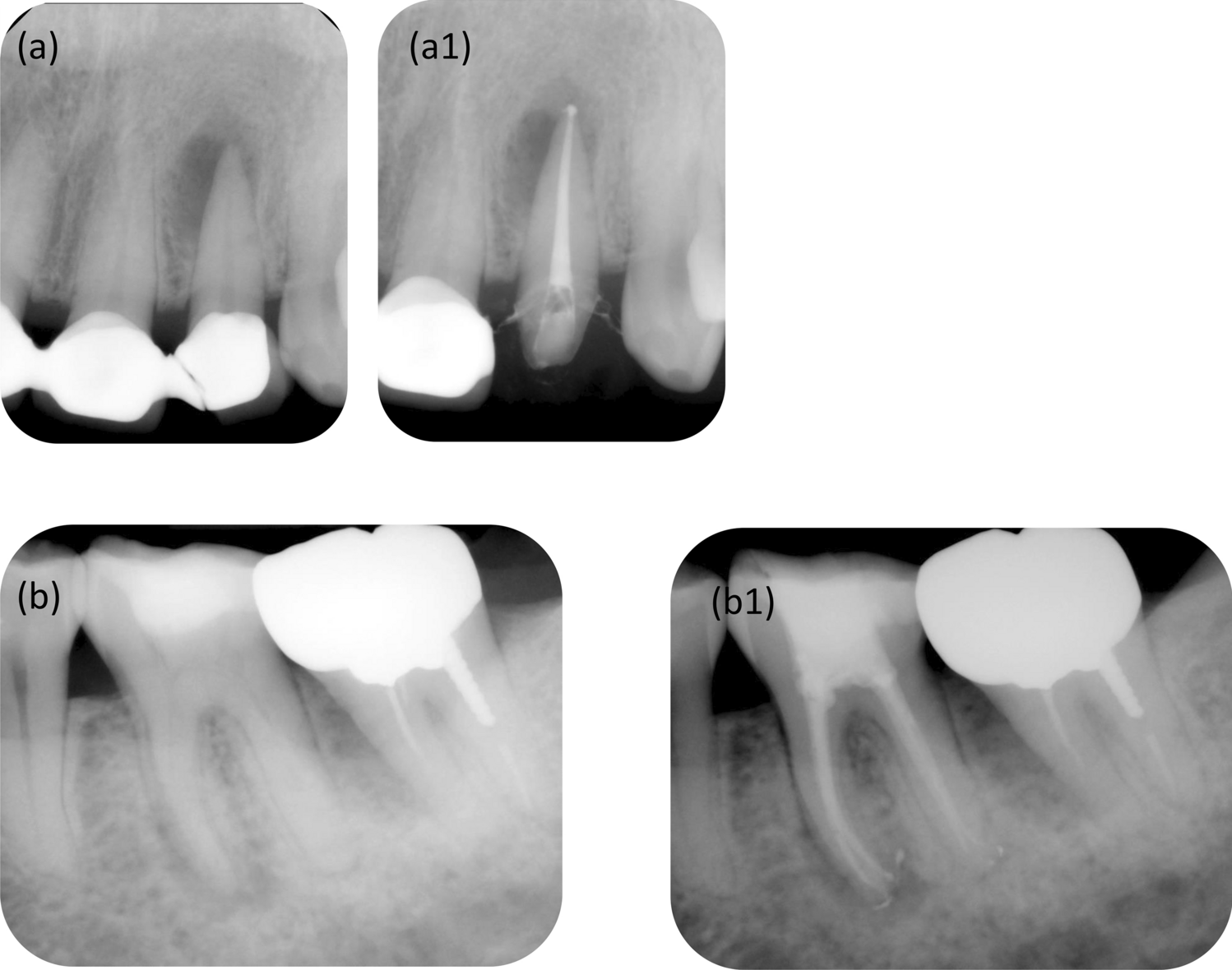 Postoperative pain of minimally invasive root canal treatment:a randomized clinical trial