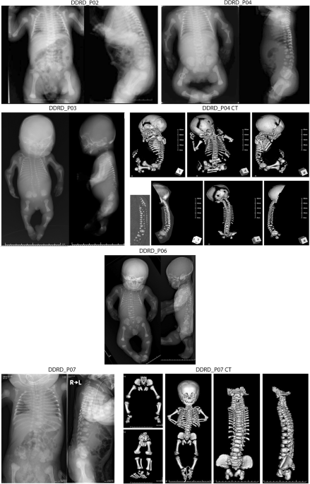 Dyssegmental dysplasia Rolland–Desbuquois type is caused by pathogenic variants in HSPG2 - a founder haplotype shared in five patients
