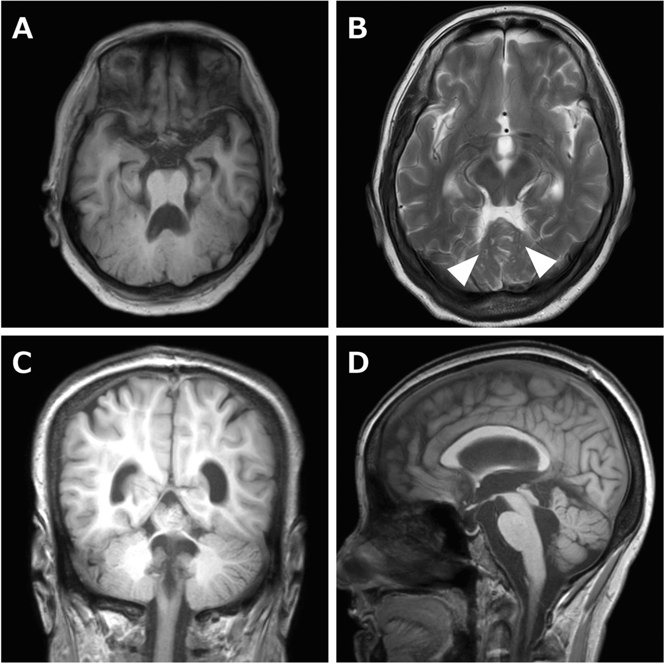 Case Report: An Adult Case of Poretti-Boltshauser Syndrome Diagnosed by Medical Checkup