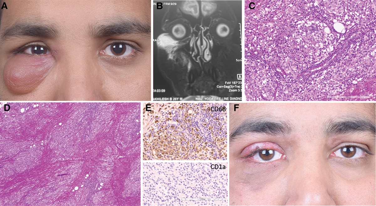 Sarcoidosis Presenting as Isolated Lower Eyelid Edema
