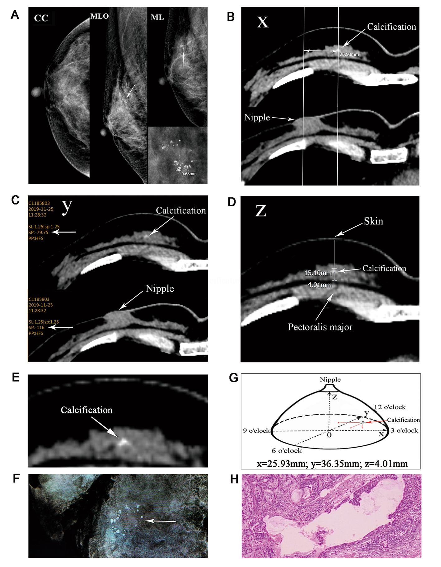 Mammographically detected breast clustered microcalcifications localized by chest thin-section computed tomography