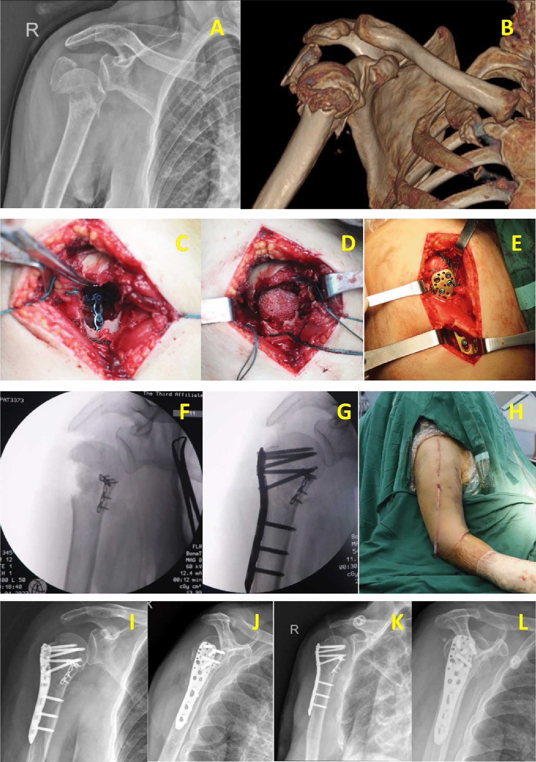 Application of Intramedullary Calcar Support Plate and Lateral Locking Plate in Elderly Patients with Neer 3 and 4-Part Fractures of Proximal Humerus Through a Deltoid Splitting Approach