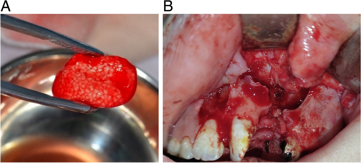 Residual calcified material volume of β–tricalcium phosphate with platelet-rich fibrin in unilateral alveolar bone graft