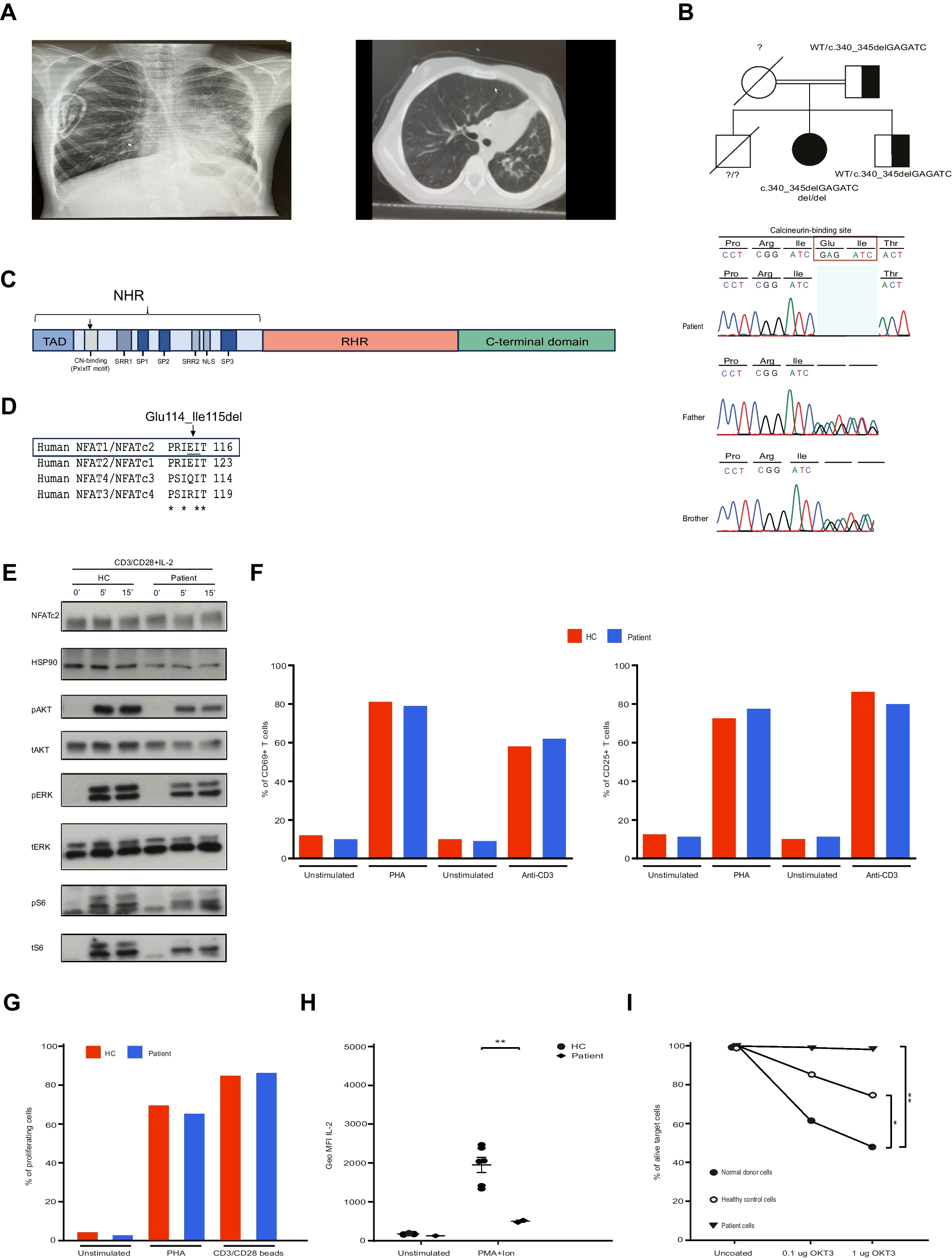 A Novel Homozygous Six Base Pair Deletion Found in the NFATC2 Gene in a Patient with EBV-Associated Lymphoproliferation