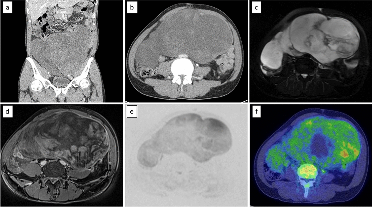 Spot scanning proton therapy for unresectable bulky retroperitoneal dedifferentiated liposarcoma: a case report