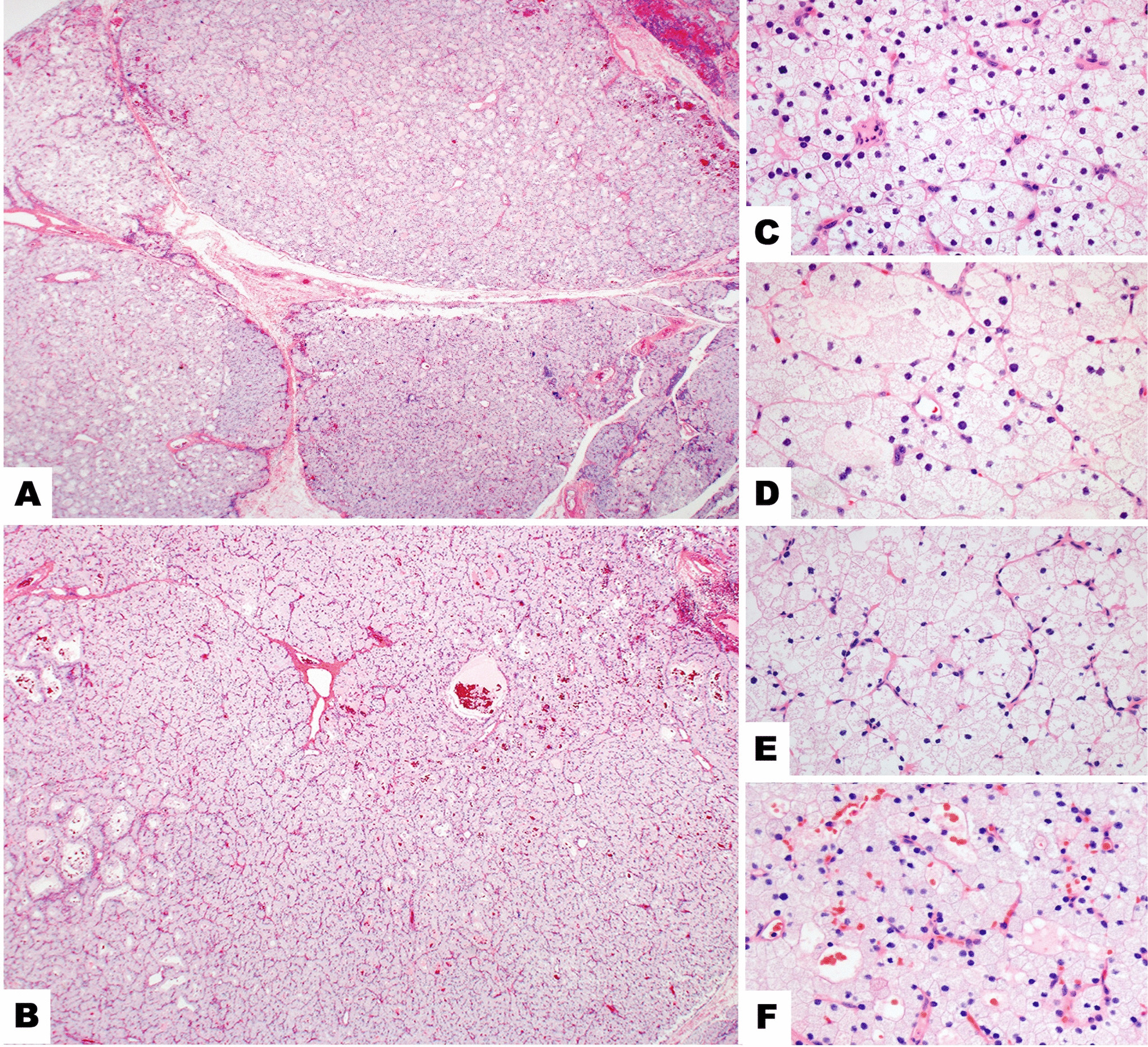 Primary Multiglandular Parathyroid Disease in the Setting of Pompe Disease