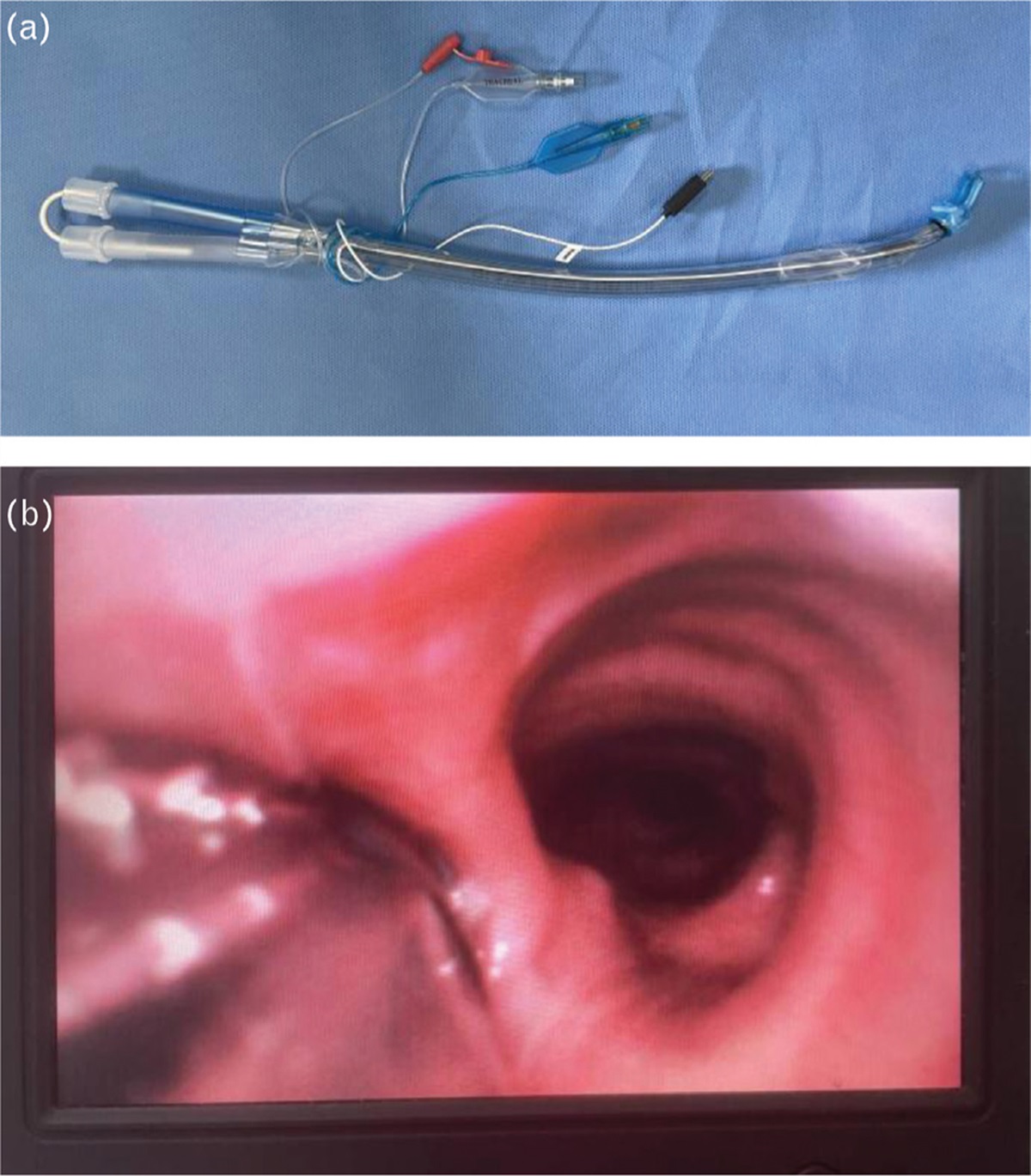 The effects of video double-lumen tubes on intubation complications in patients undergoing thoracic surgery: A randomised controlled study