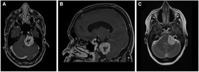 Case Report: Use of novel AR registration system for presurgical planning during vestibular schwannoma resection surgery
