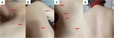 Case report: Cutaneous metastases as a first manifestation from breast cancer with concurrent gastric metastases