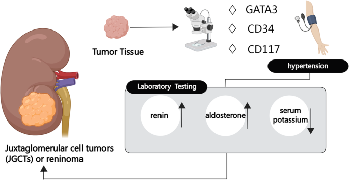 Clinical features, laboratory findings and treatment of juxtaglomerular cell tumors: a systemic review