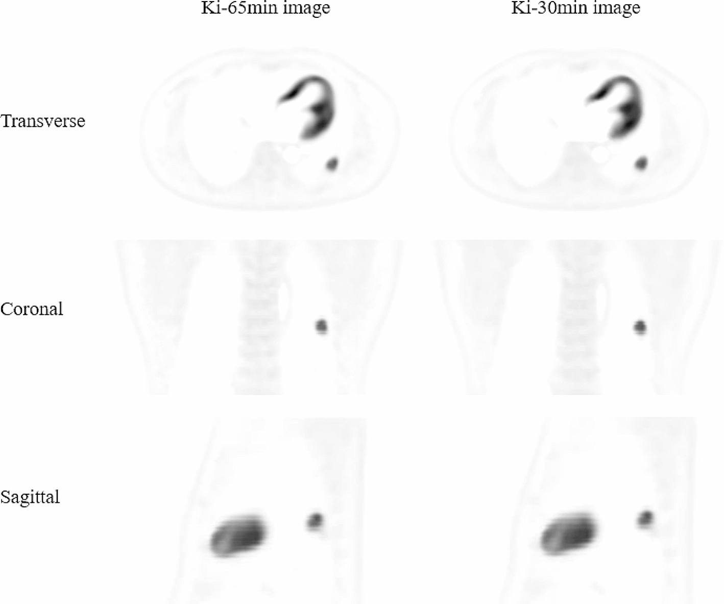 Clinical feasibility study of early 30-minute dynamic FDG-PET scanning protocol for patients with lung lesions