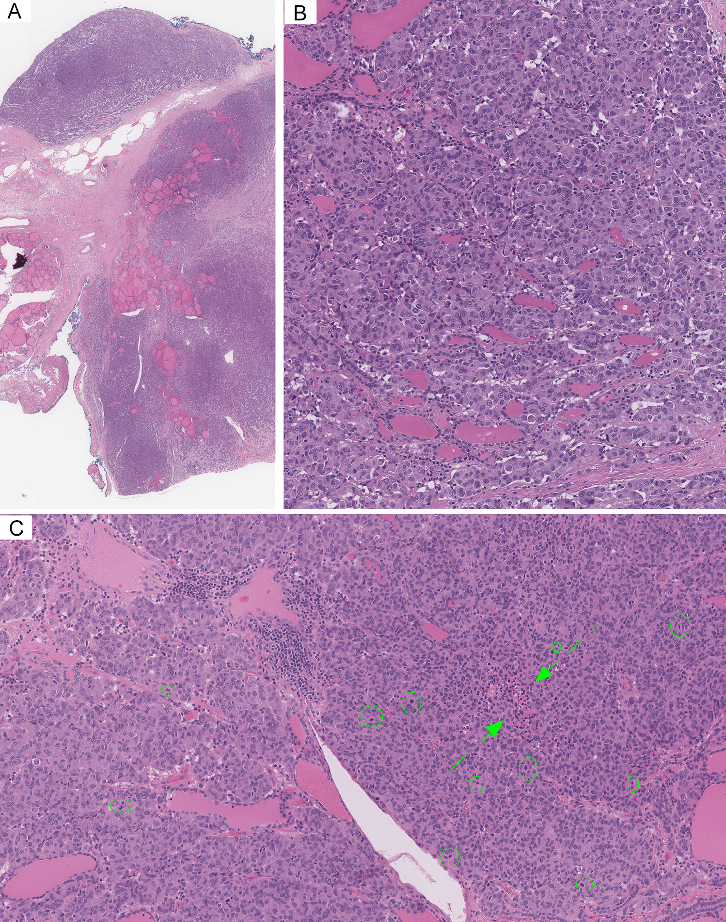 Uncommon Mimicker of a High-Grade Thyroid Carcinoma: Solitary Thyroid Metastasis of Gastrointestinal Stromal Tumor (GIST)