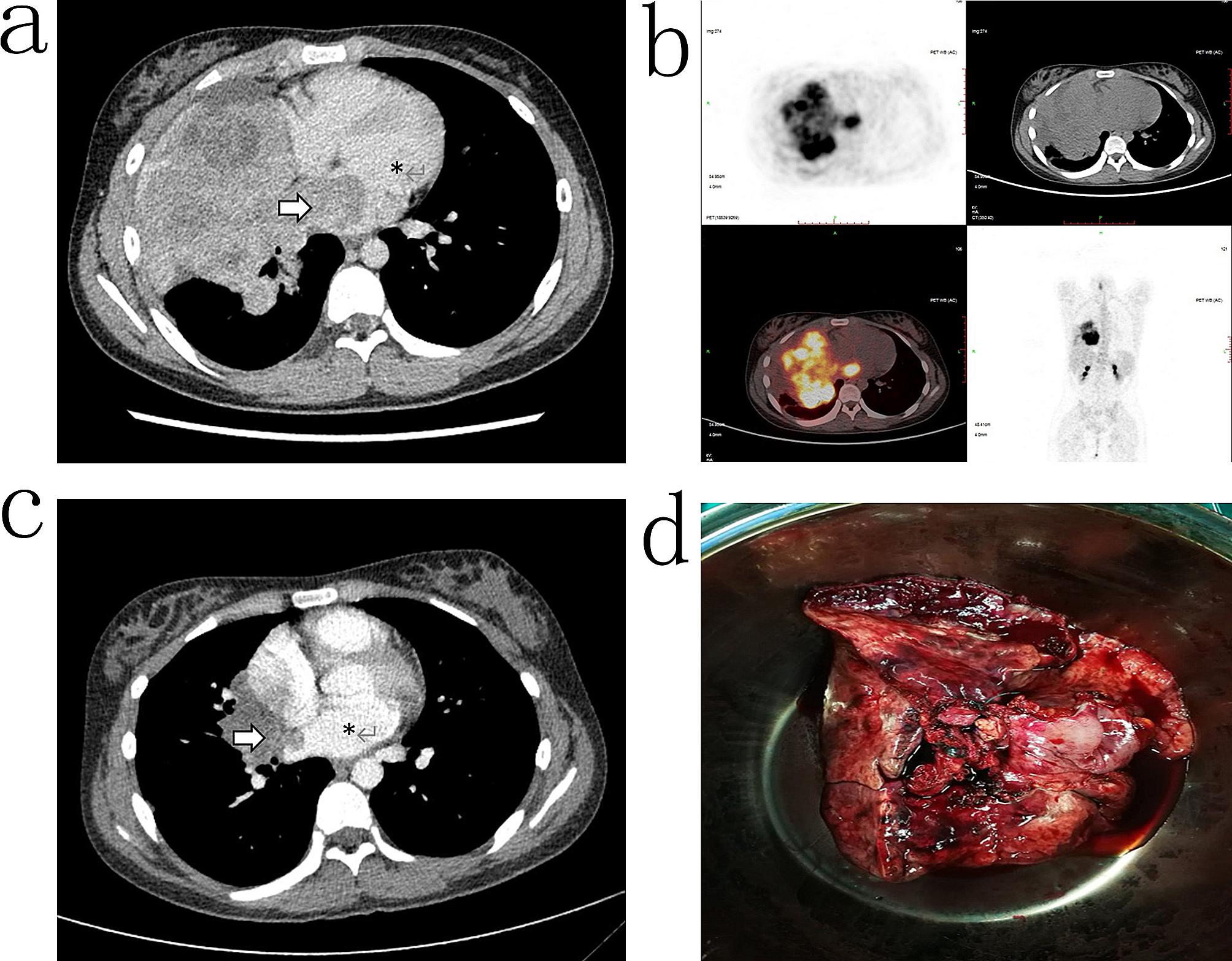 Operative treatment of pulmonary primitive neuroectodermal tumor: a case report and literature review