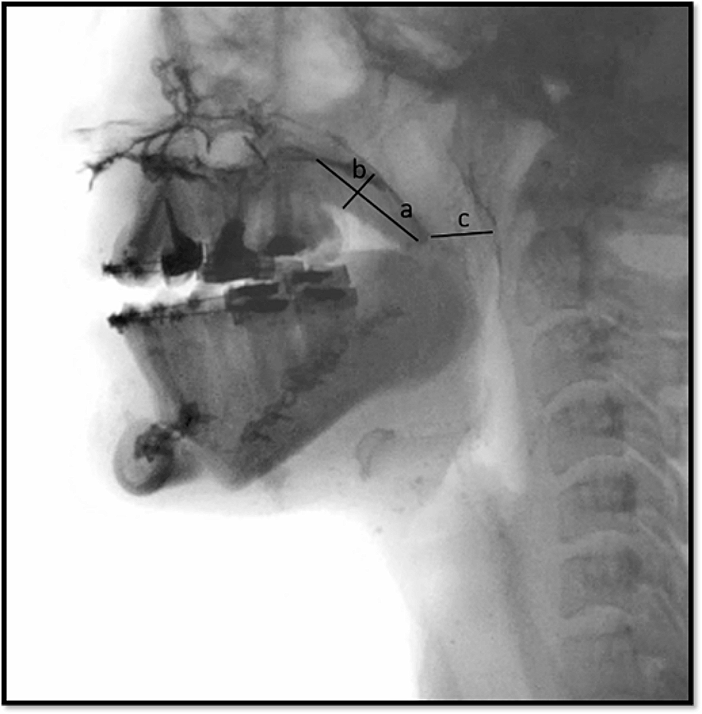 Speech following Le Fort I Maxillary Advancement in Cleft Maxillary hypoplasia – an objective and subjective outcome analysis
