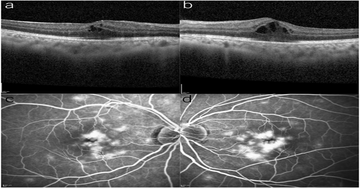 Cystoid Macular Edema After Initiation of Ozanimod for Ulcerative Colitis