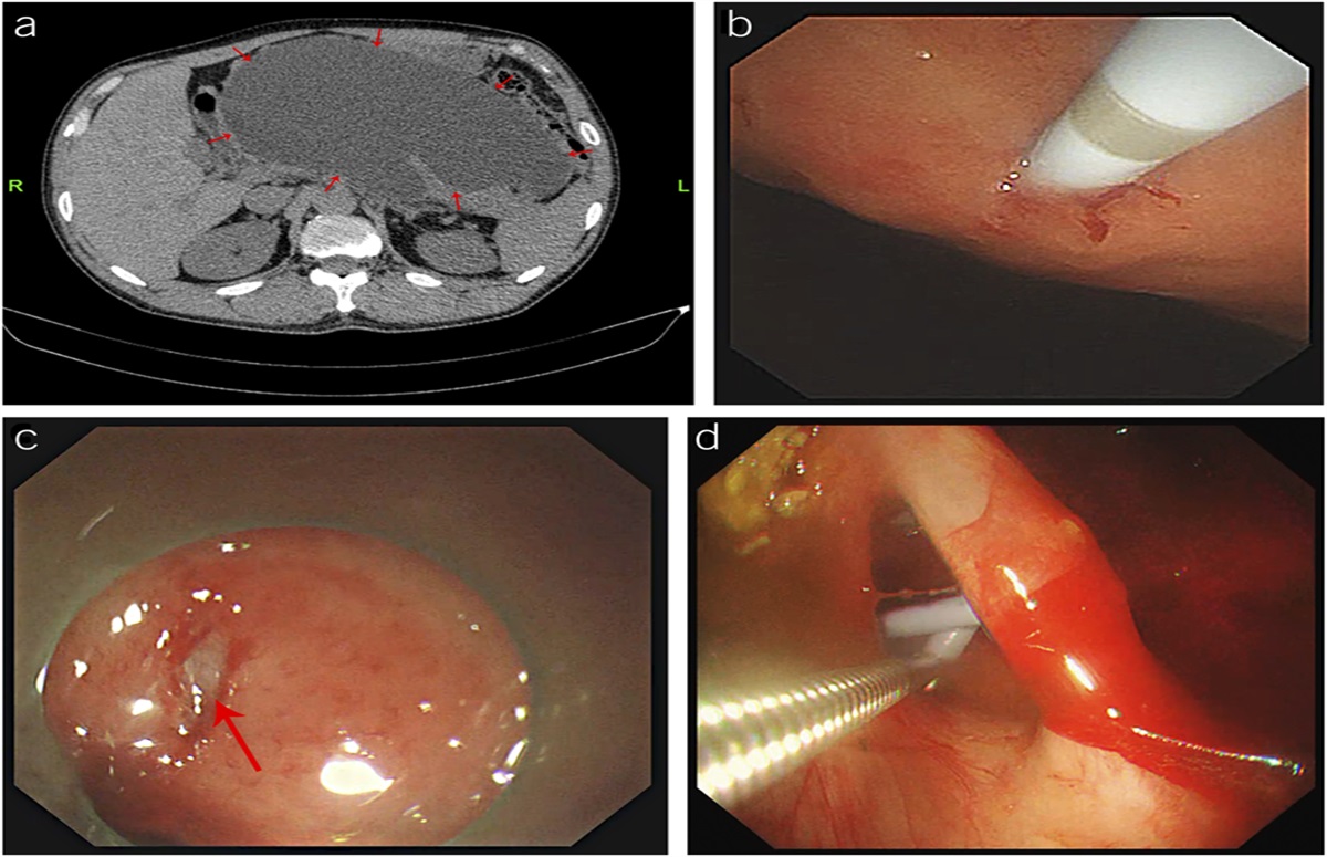 Emergency Pancreatic Pseudocyst Exploration to Retrieve a Stent: A Nerve-Wracking Migration