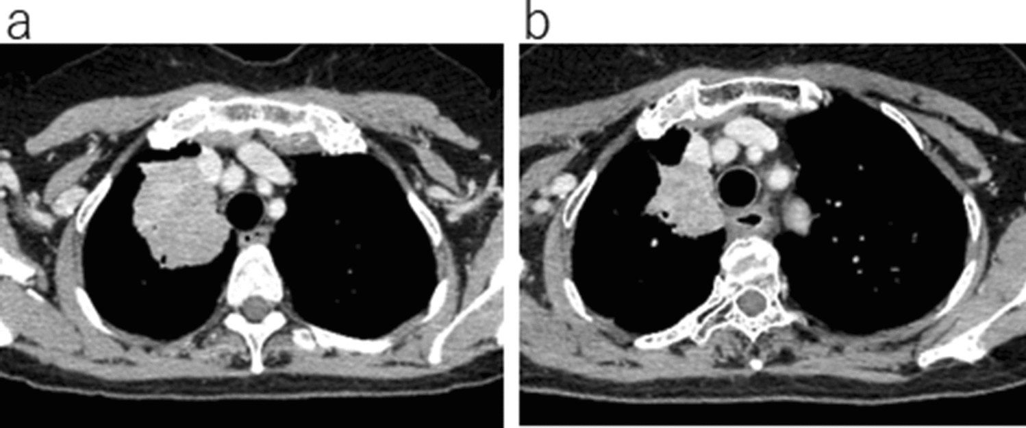 EGFR-mutated lung adenocarcinoma with choroidal oligometastasis during treatment with gefitinib: a case report