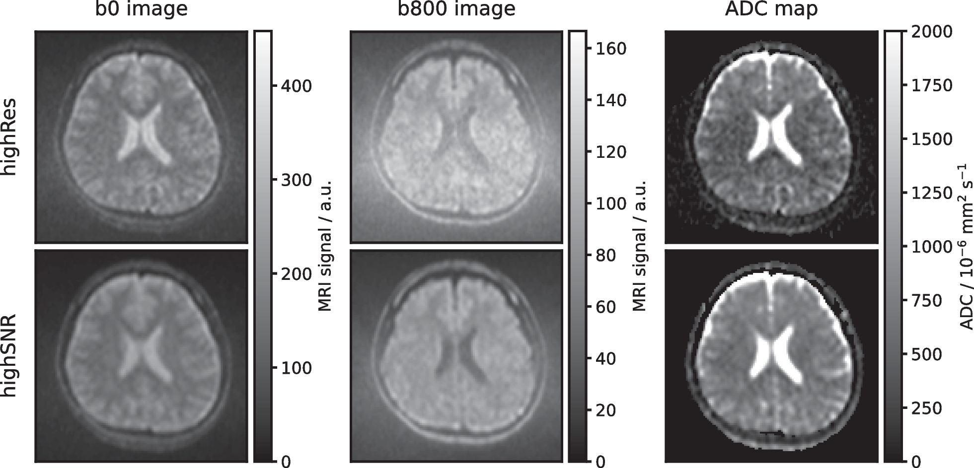 Repeatability quantification of brain diffusion-weighted imaging for future clinical implementation at a low-field MR-linac