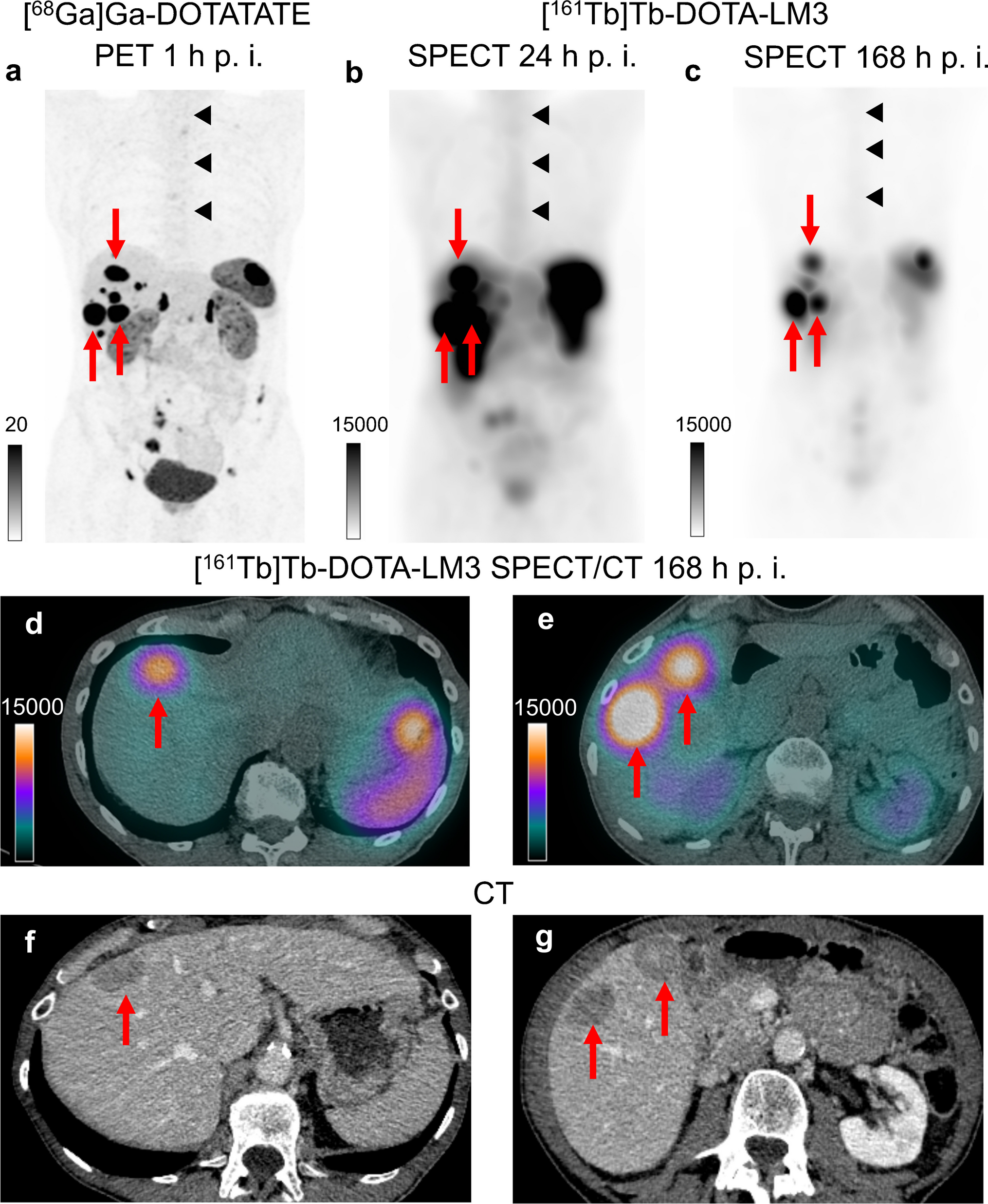 First-in-human administration of terbium-161-labelled somatostatin receptor subtype 2 antagonist ([161Tb]Tb-DOTA-LM3) in a patient with a metastatic neuroendocrine tumour of the ileum