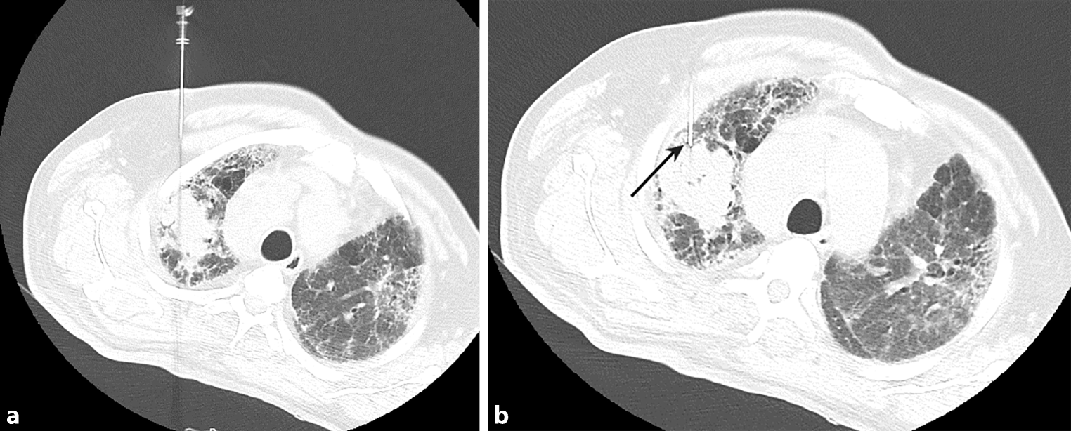 Systemic arterial air embolism following CT-guided lung biopsy