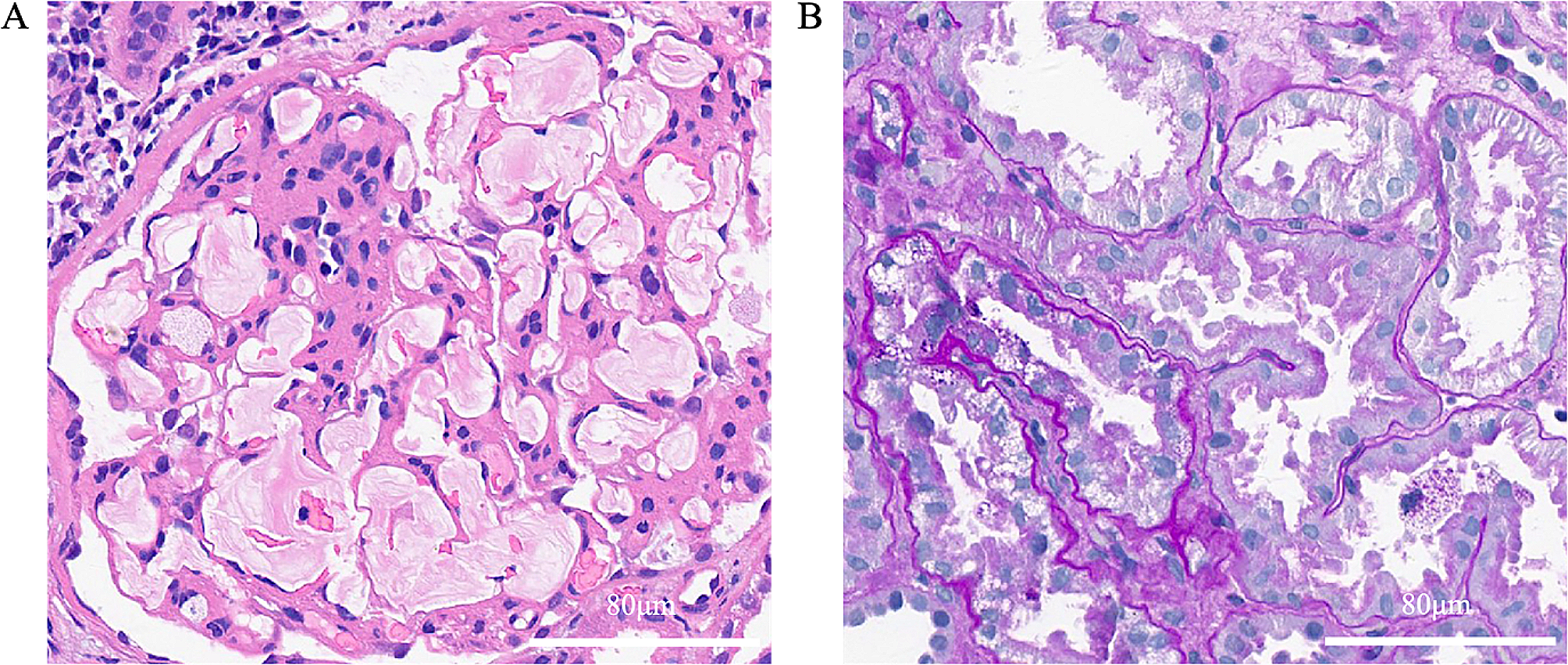 A case report of youth-onset lipoprotein glomerulopathy with APOE Chicago mutation