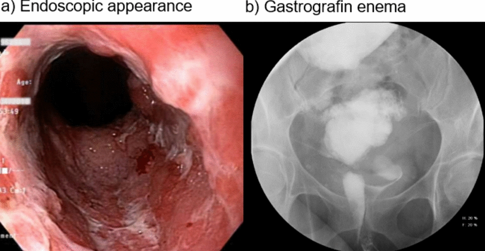 Redo IPAA for long rectal cuff syndrome after ileoanal pouch for inflammatory bowel disease