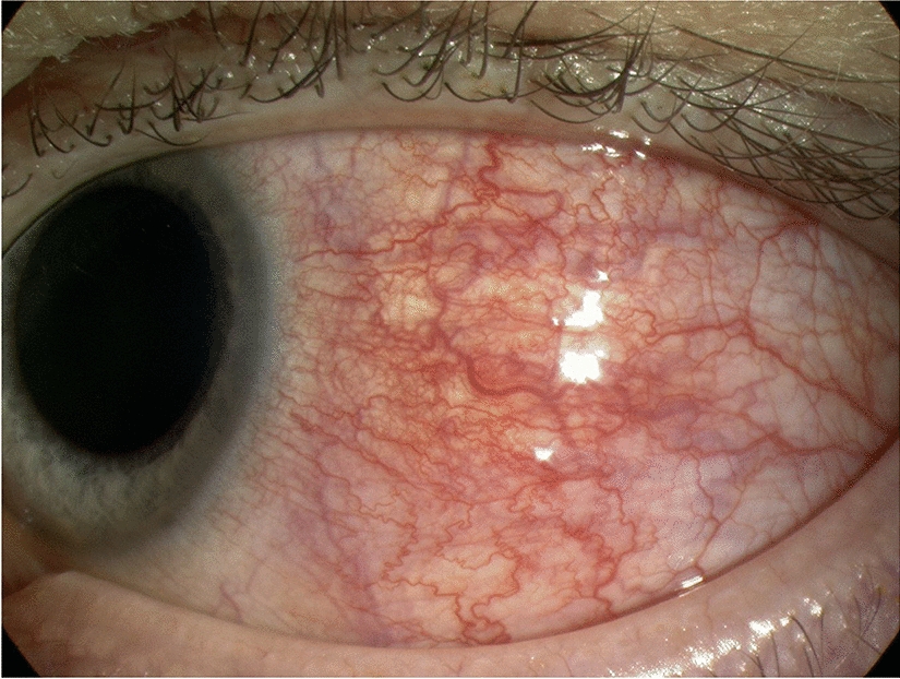 Management of Scleritis in Older Adults