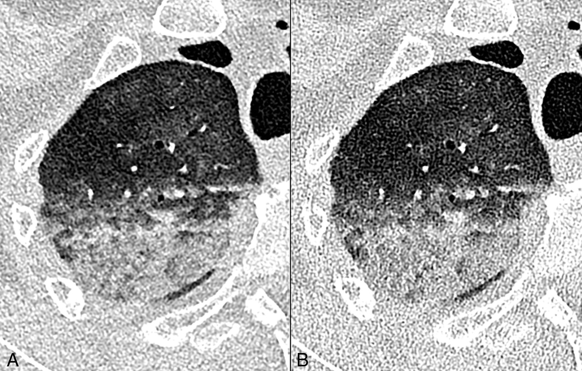 Investigating the Small Pixel Effect in Ultra-High Resolution Photon-Counting CT of the Lung