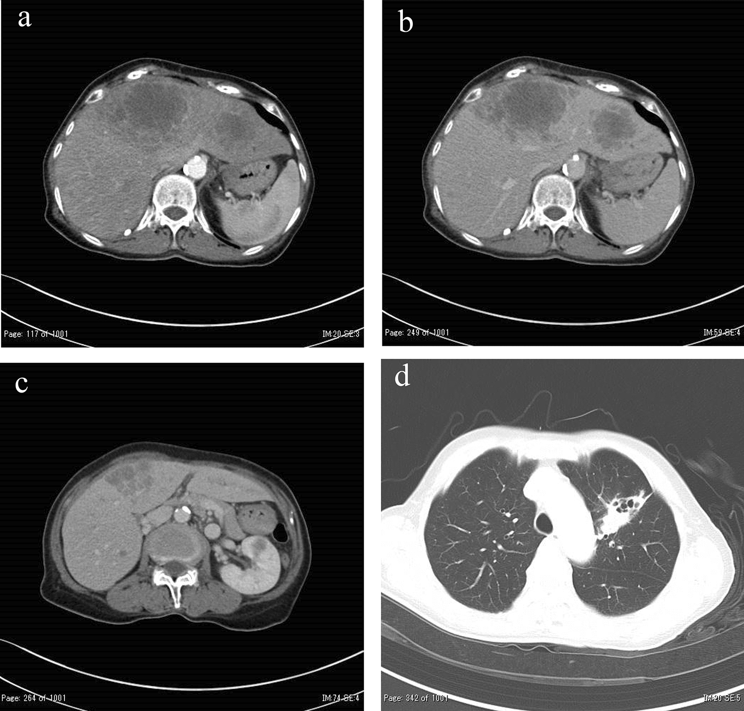 Simultaneous gastric, pancreatic, and renal metastasis from poorly differentiated hepatocellular carcinoma