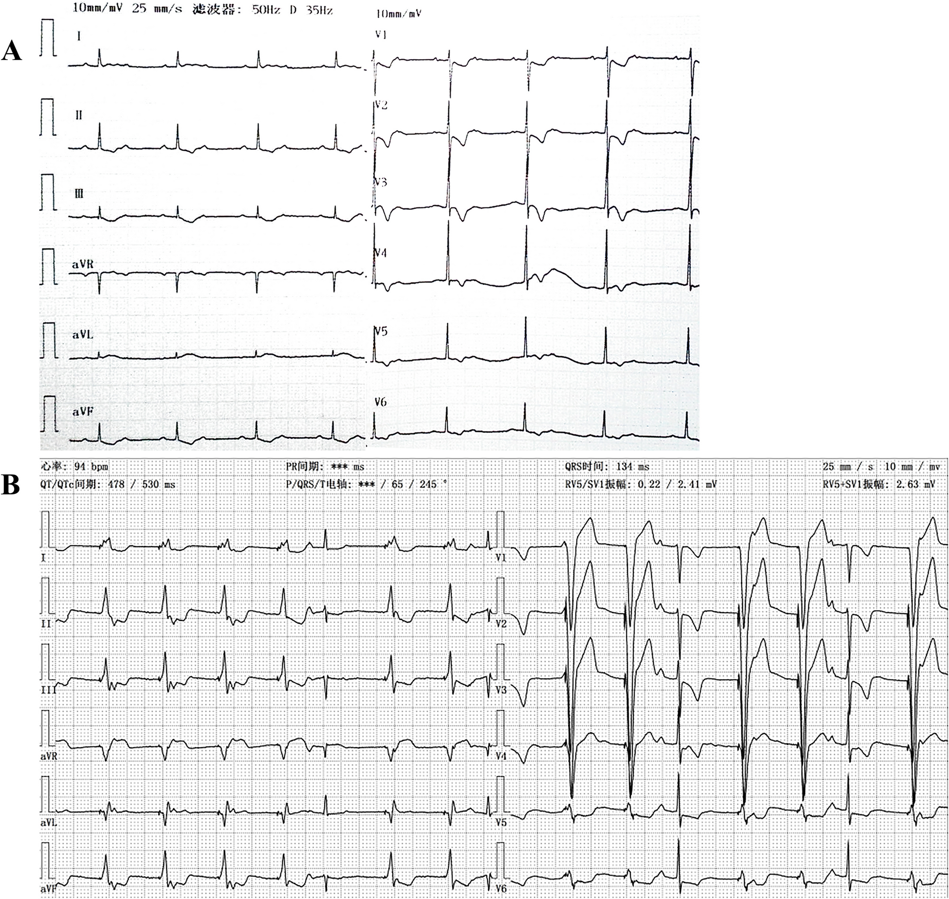 Transvenous endocardial pacing with SelectSecure™ 3830 lead in pediatric patients: case series of two infants and a literature review
