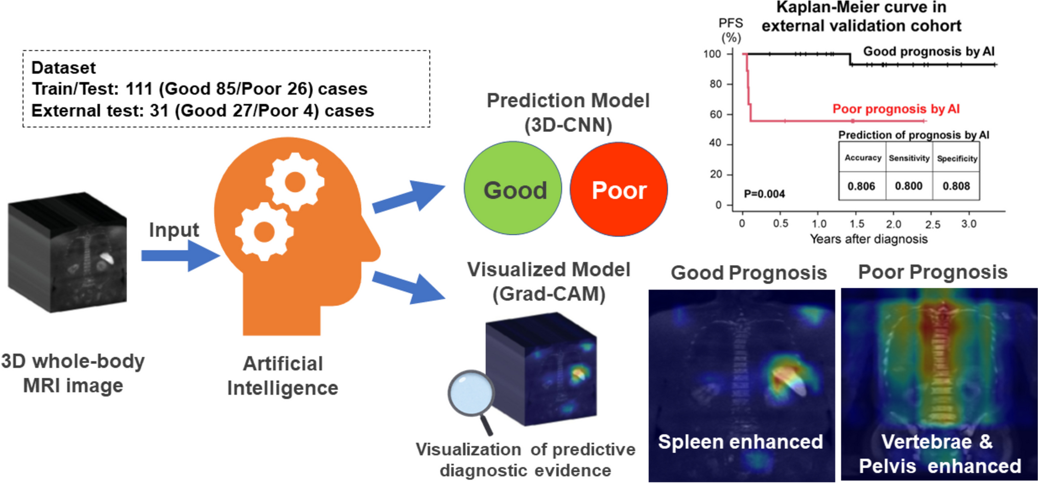 3D CNN-based Deep Learning Model-based Explanatory Prognostication in Patients  with Multiple Myeloma using Whole-body MRI