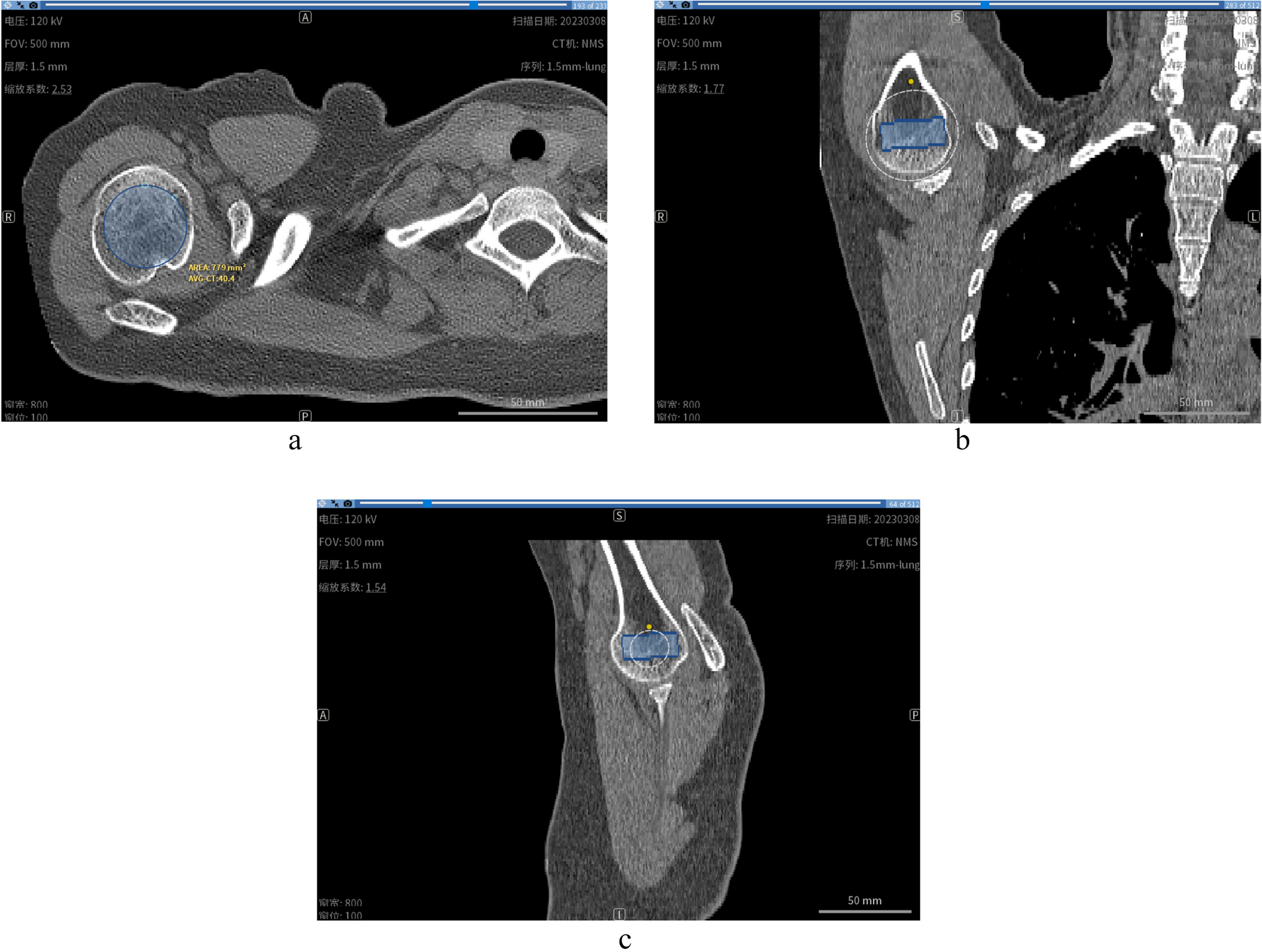 Semi-automatic proximal humeral trabecular bone density assessment tool: technique application and clinical validation