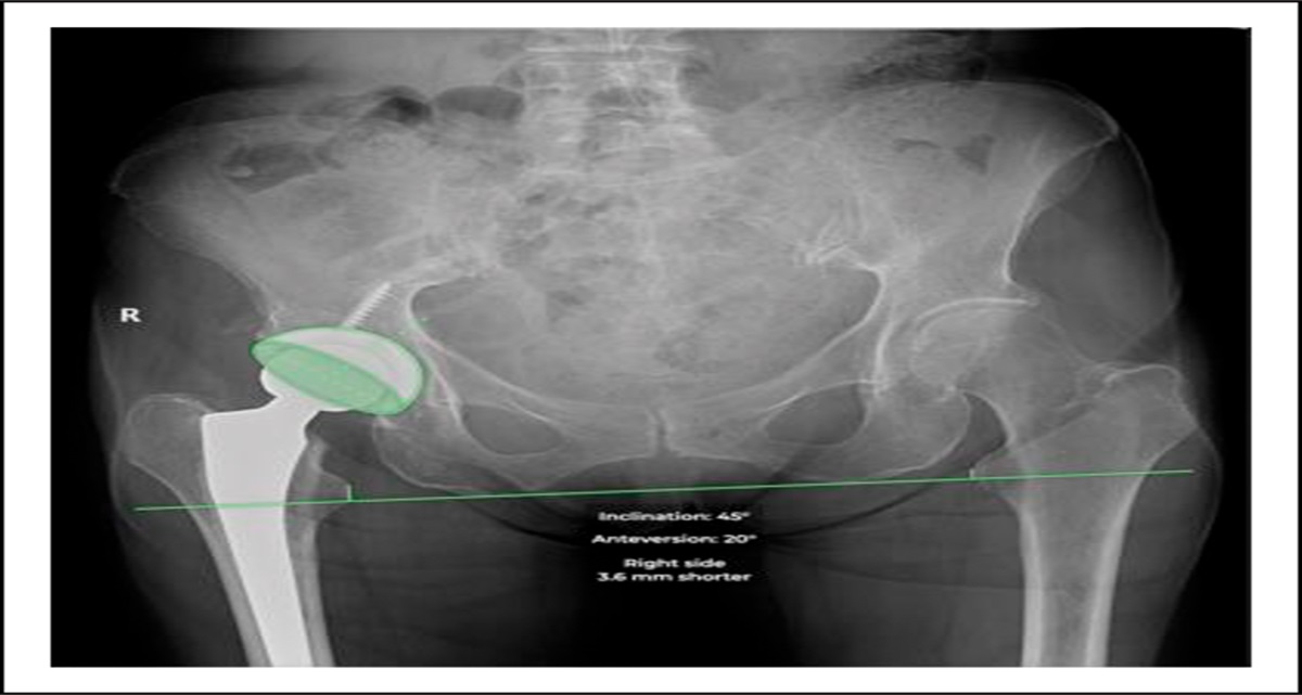 Fluoroscopy Versus Imageless Optical Navigation in Direct Anterior Approach Total Hip Arthroplasty
