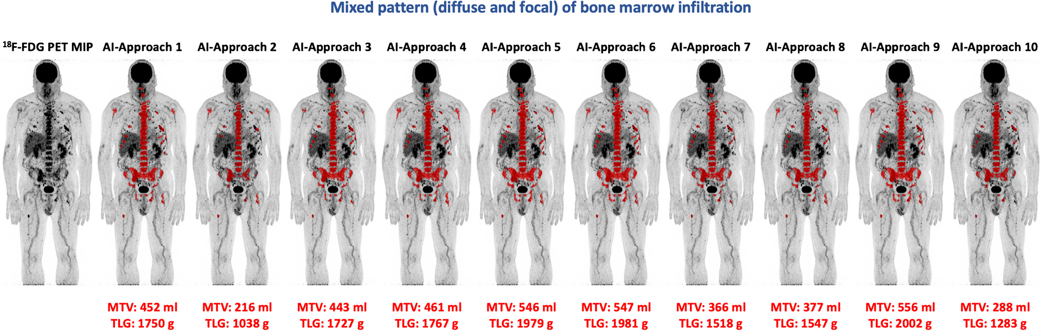 Artificial intelligence–based, volumetric assessment of the bone marrow metabolic activity in [18F]FDG PET/CT predicts survival in multiple myeloma