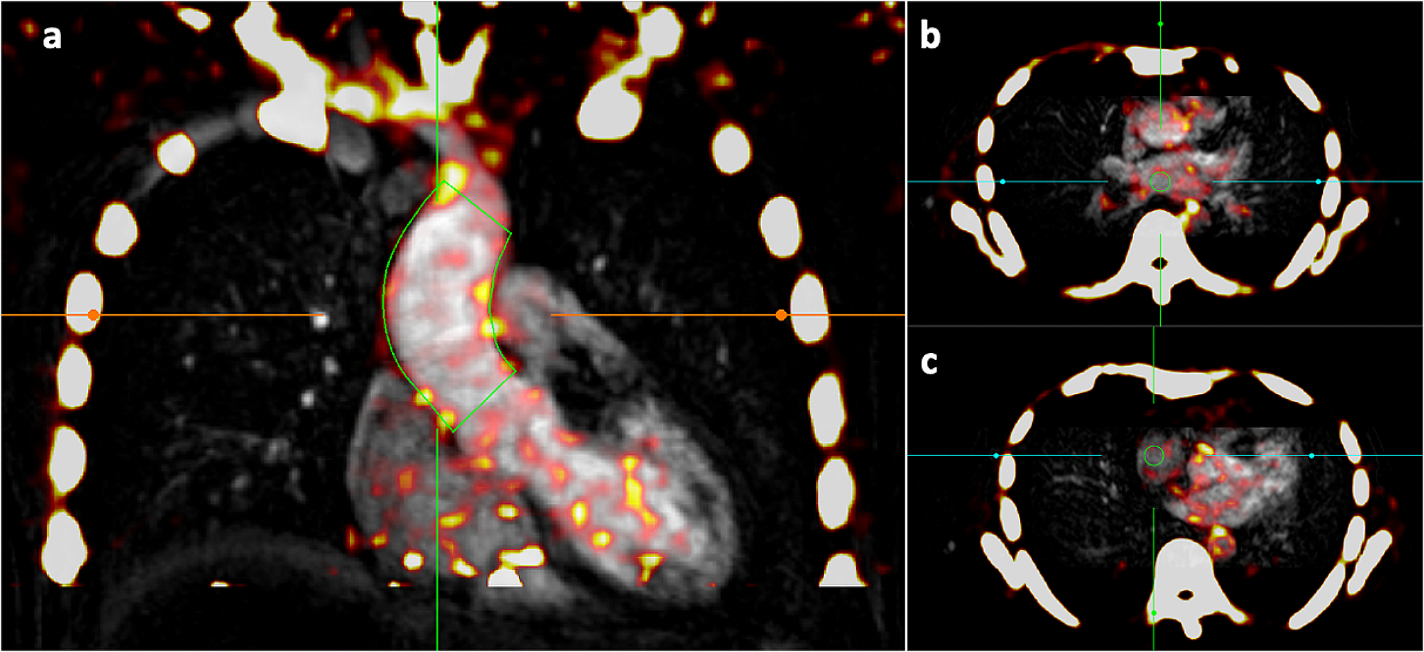 Thoracic aortic microcalcification activity in combined positron emission tomography and magnetic resonance imaging