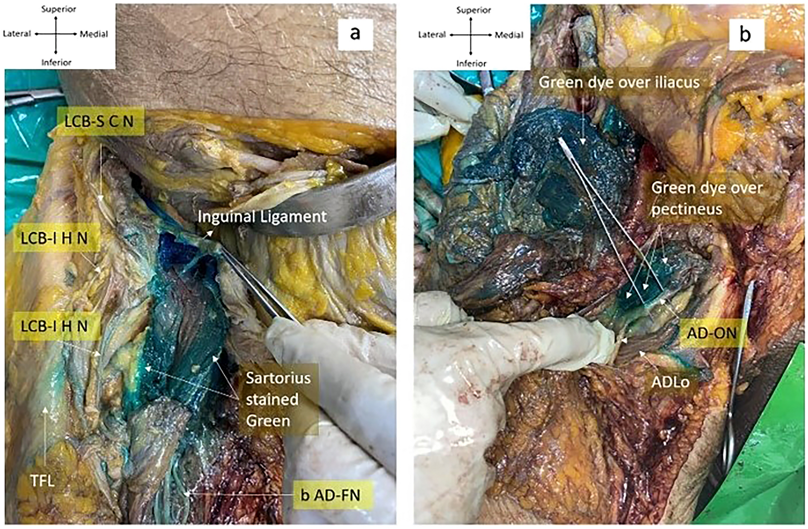 Anatomic evaluation to compare the dye spread with ultrasound-guided pericapsular nerve group (PENG) injection with or without an additional suprainguinal fascia iliaca (SIFI) injection in soft embalmed cadavers