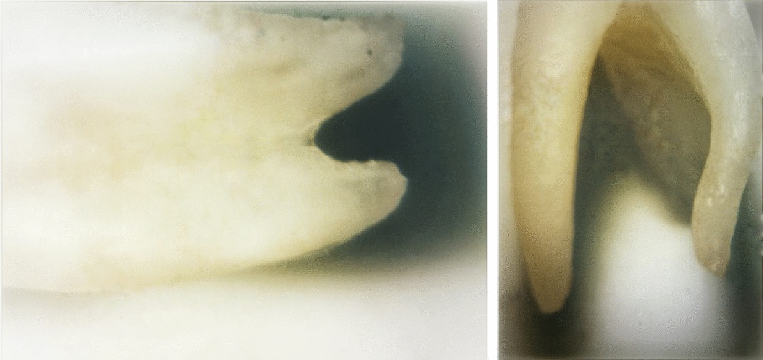 Comparative evaluation of hand and rotary file systems on dentinal microcrack formation during pulpectomy procedure in primary teeth: an in vitro study