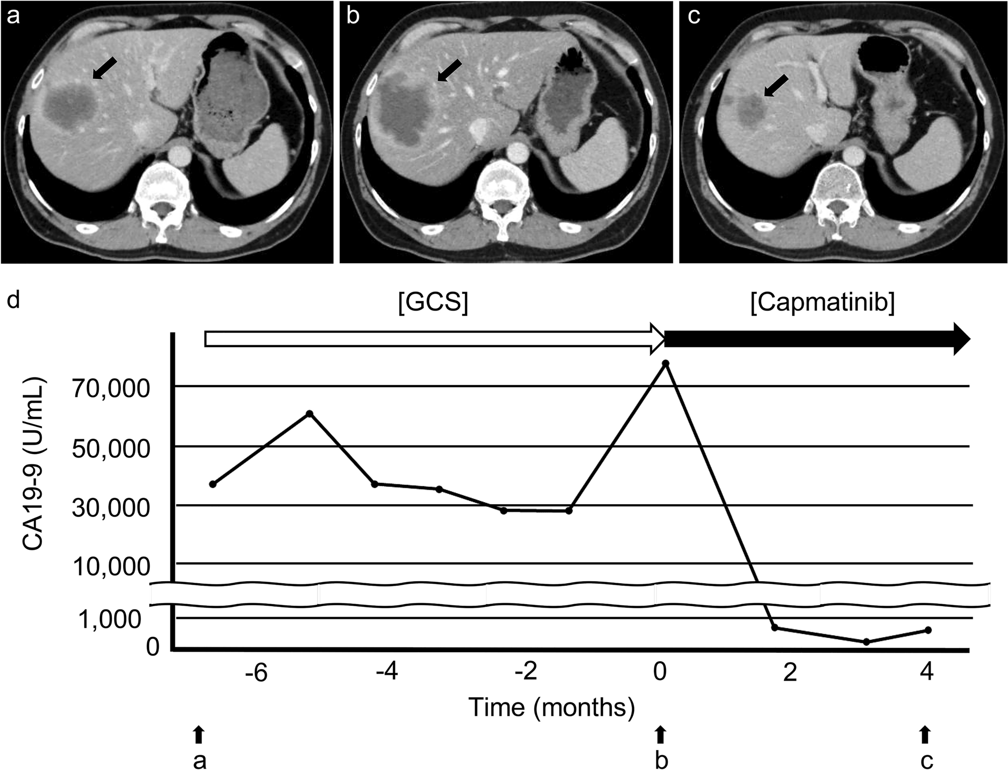 Remarkable response to capmatinib in a patient with intrahepatic cholangiocarcinoma harboring TFG-MET fusion