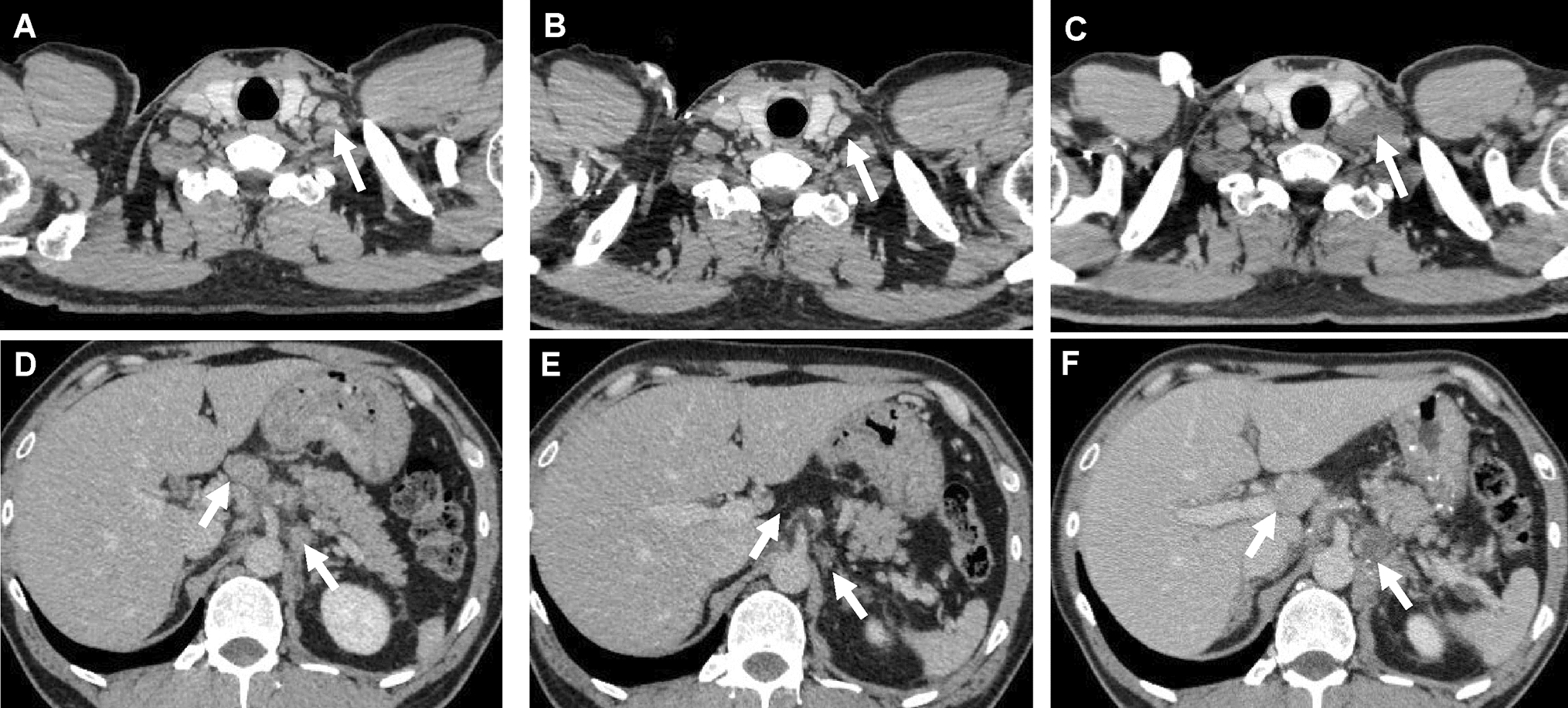 A case of treatment-resistant advanced gastric cancer with FGFR2 gene alteration successfully treated with pemigatinib