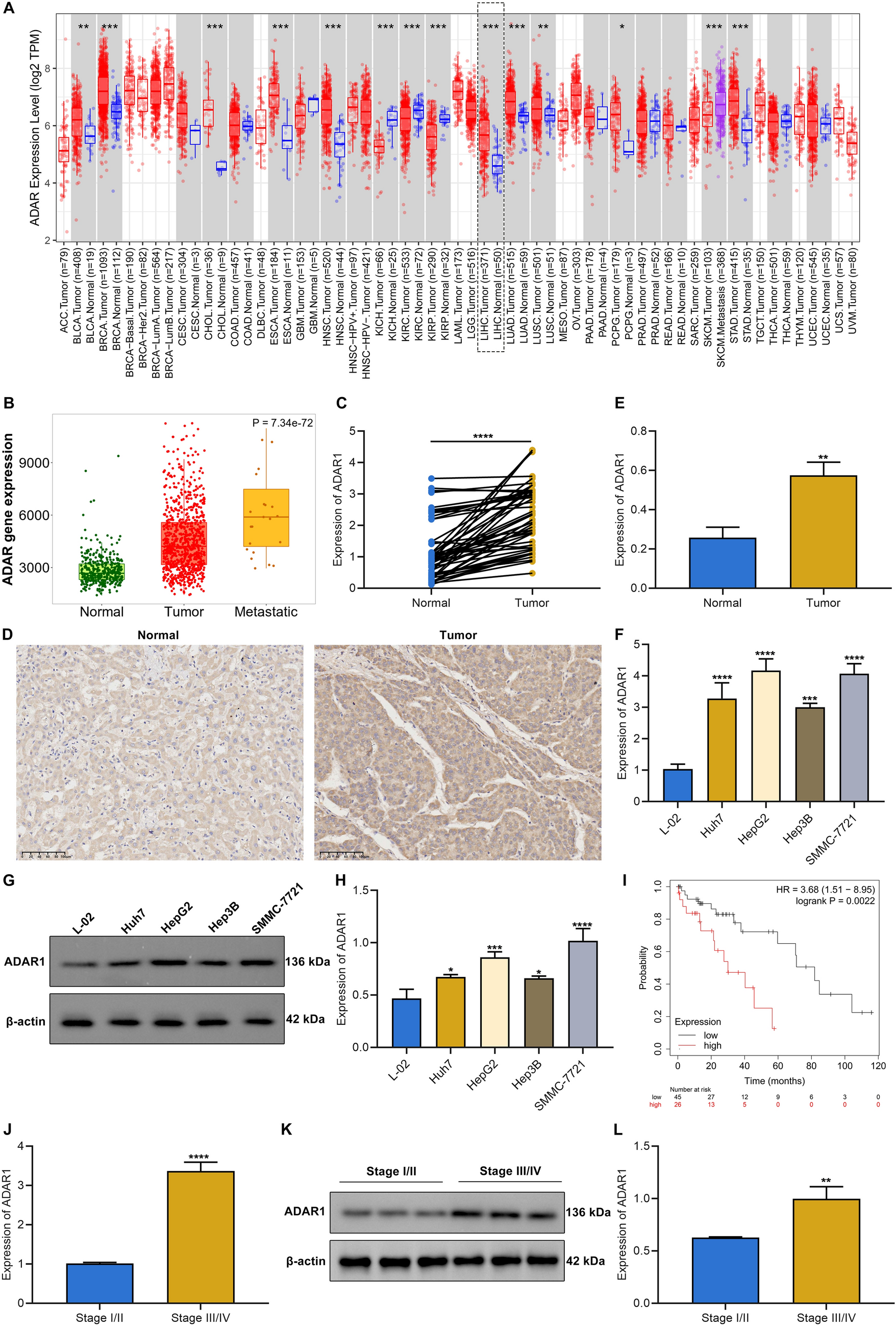 Suppression of A-to-I RNA-editing enzyme ADAR1 sensitizes hepatocellular carcinoma cells to oxidative stress through regulating Keap1/Nrf2 pathway