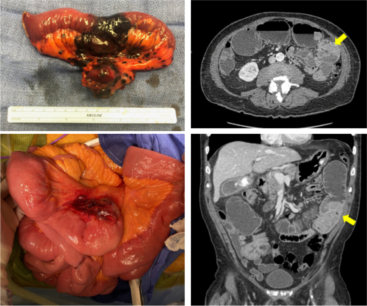 Metastatic melanoma to small bowel: metastasectomy is supported in the era of immunotherapy and checkpoint inhibitors