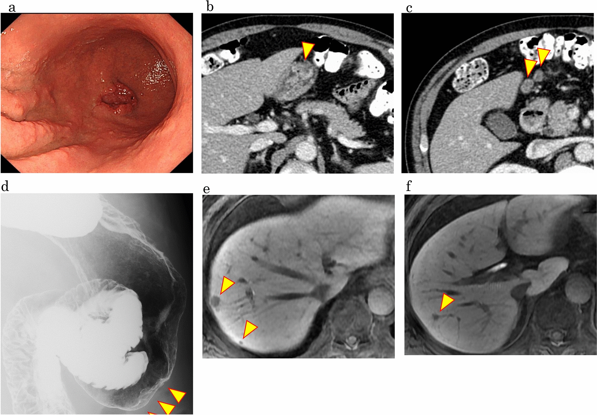 Conversion surgery for stage IV gastric cancer with multiple liver metastases with a complete pathological response to S-1 plus oxaliplatin therapy