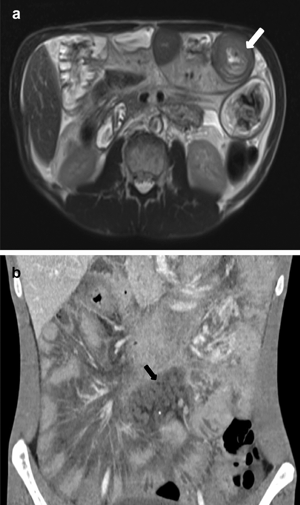 Diffuse abdominal lymphangiomatosis without tumoral masses: a case report