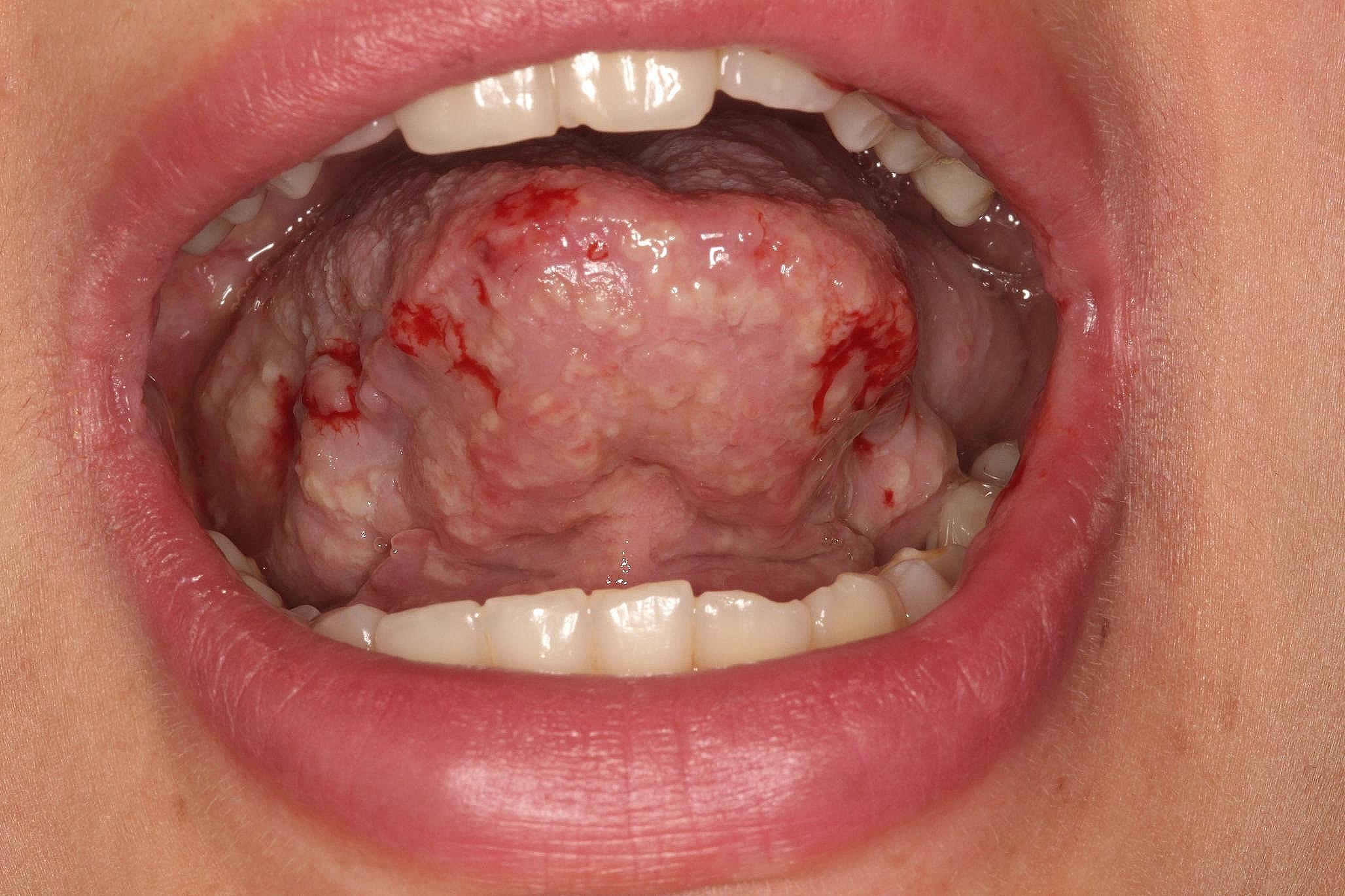 Pyodermatitis-pyostomatitis vegetans: a case report and systematic review focusing on oral involvement