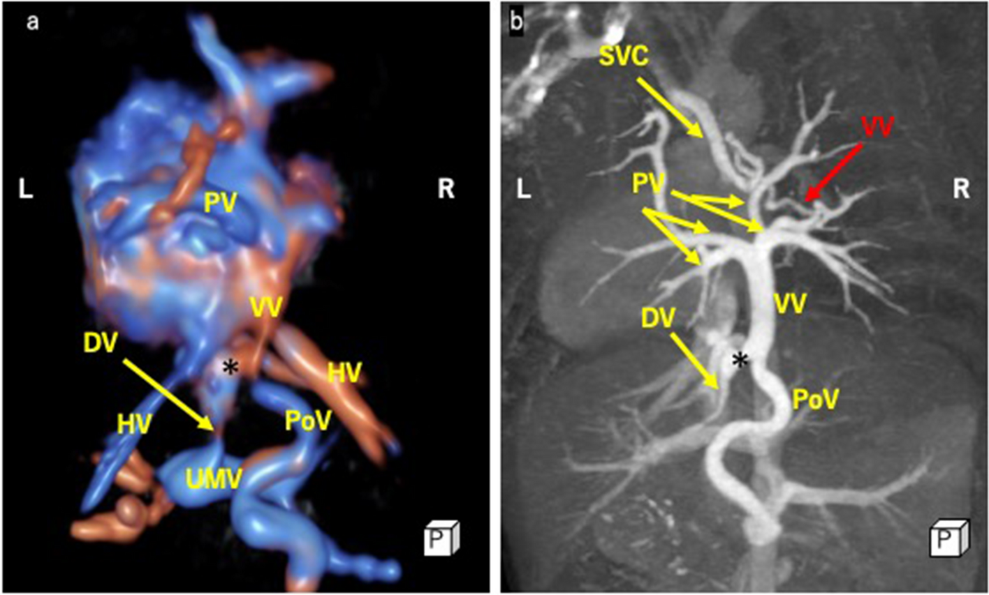 Prenatal diagnosis of total anomalous pulmonary venous connection with vertical vein branching into two