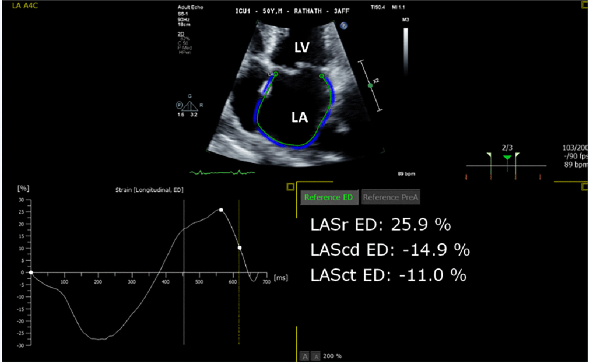Incremental diagnostic and prognostic utility of left atrial deformation in heart failure using speckle tracking echocardiography