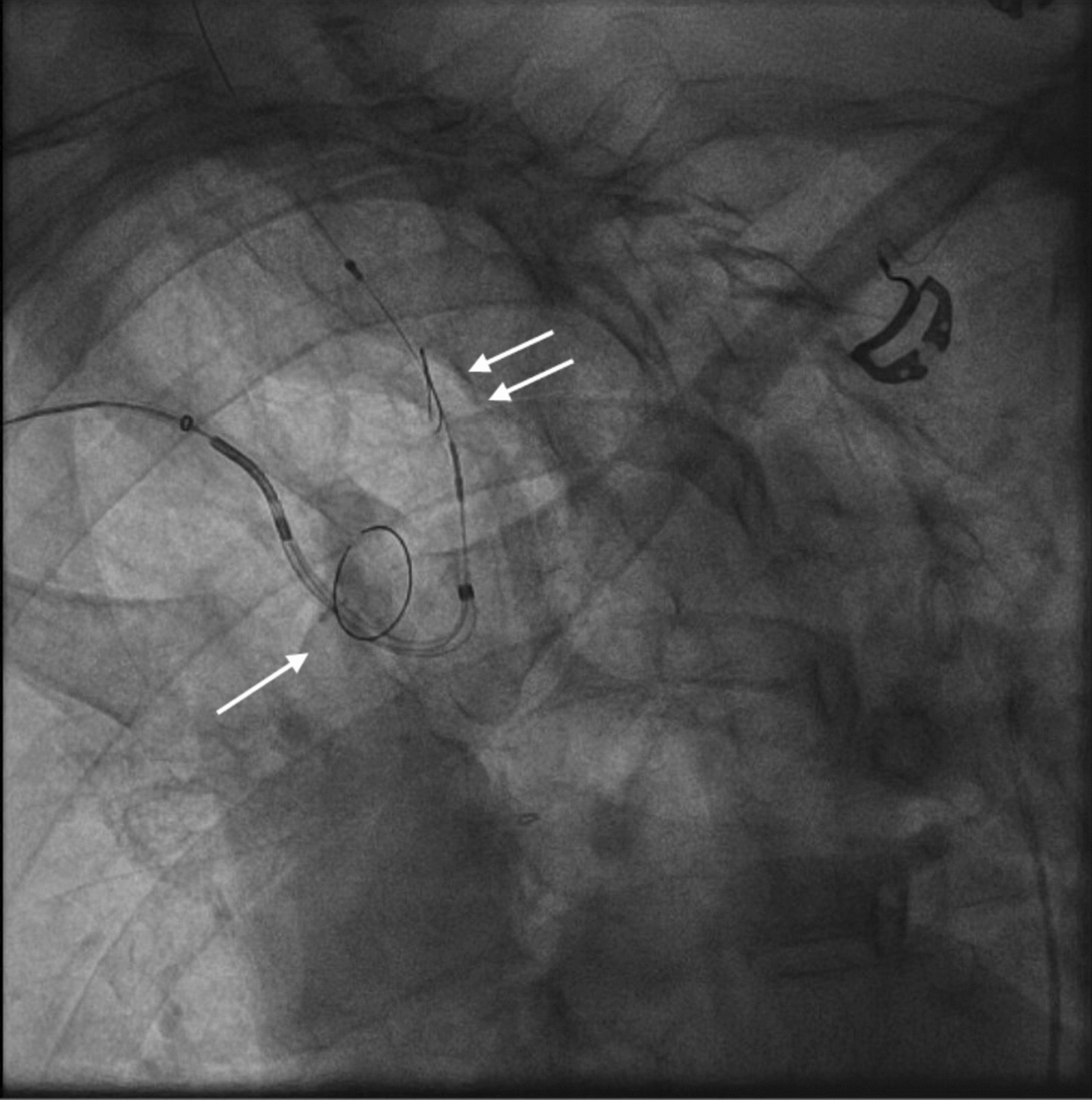 Cerebral Embolic Protection Devices for Transcatheter Aortic Valve Replacement: Review of the Literature and Future Perspectives